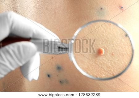 Dermatologist looking at skin of human with birthmark through magnifier, closeup