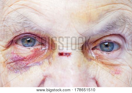 Close up picture of an elderly woman's injured eye & face - domestic violence