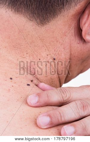 Finger Embrace Mole On Neck And Shoulder Of Asian Male