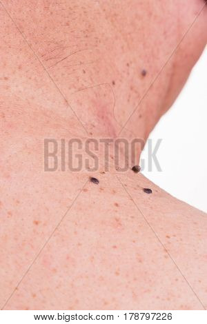 Multiple Mole On Neck And Shoulder Of Asian Male