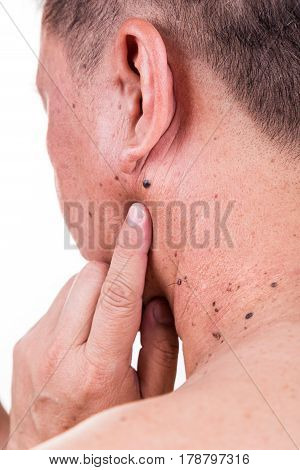 Finger Embrace Mole On Neck And Shoulder Of Asian Male