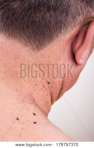 Multiple Mole On Neck And Shoulder Of Asian Male