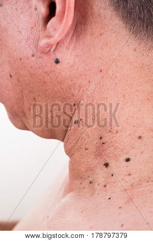 Multiple Mole On Neck And Shoulder Of Asian Male