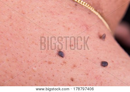 Closeup Of Multiple Moles On Shoulder Of Asian Man