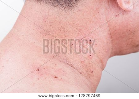 Mole Removed Via Skin Graft Procedure Leaving Scar