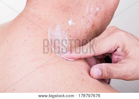 Man Applying Antibiotic Cream Onto Wound From Removed Mole