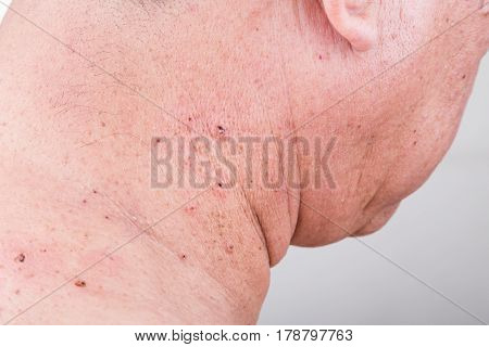 Mole Removed Via Skin Graft Procedure Leaving Scar