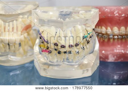 Human jaw or teeth orthodontic dental model with implants dental braces