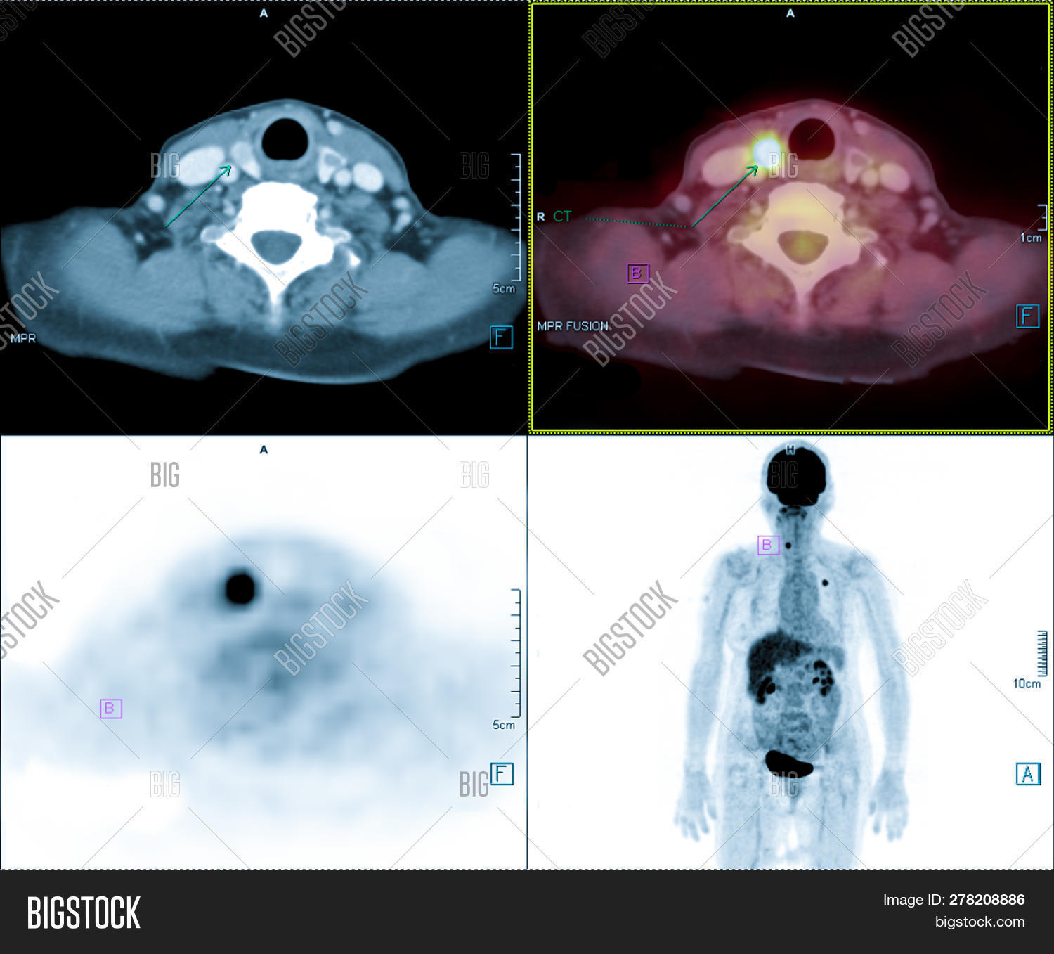 Pet/ct Thyroid Gland Image & Photo (Free Trial) Bigstock