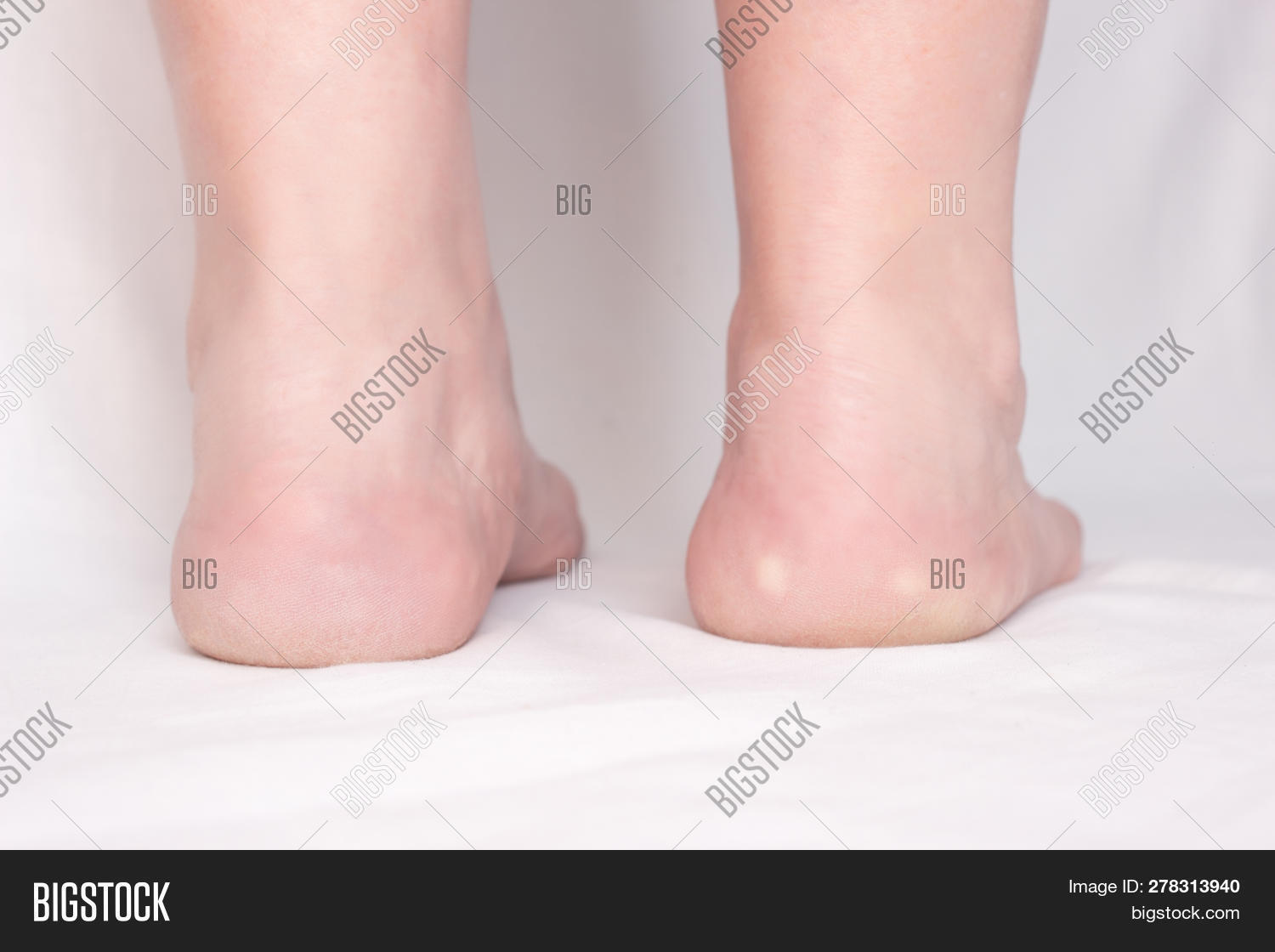 White Spots On Feet
