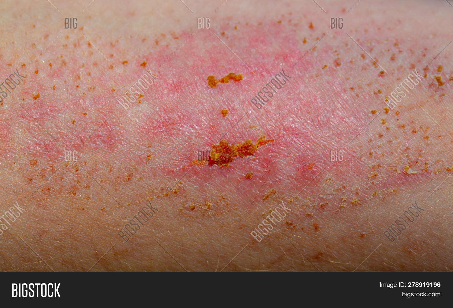 Wound On Skin. Scab. Image & Photo (Free Trial) Bigstock