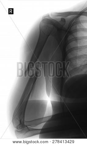 X-ray Of The Brachial Bone. Helical Humeral Fracture. Negative.