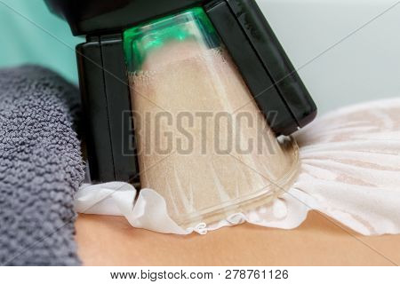 Close-up View Of Cryolipolysis Treatment. Hardware Cosmetology, Noninvasive Technology Of Fat Reduct