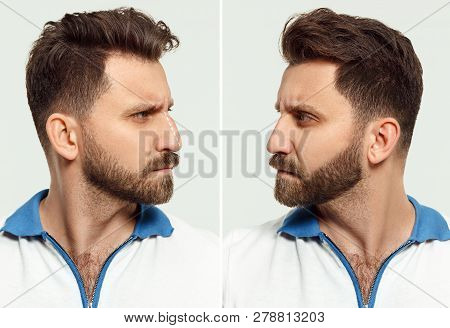 The Male Face Before And After Cosmetic Nose Surgery. Over White Background. Before And After Concep