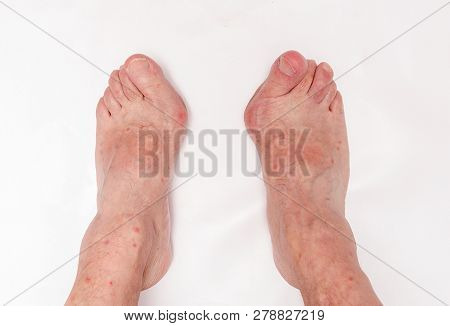 Hallux Abductus Valgus