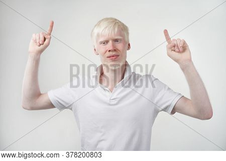 Albinism Albino Man White Skin Hair Studio Dressed T-shirt Isolated White Background Abnormal Deviat