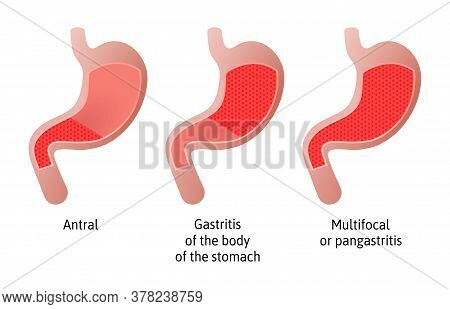 Location Of Gastritis, An Inflammation Of The Lining Of The Stomach. Three Types Antral, Of The Body