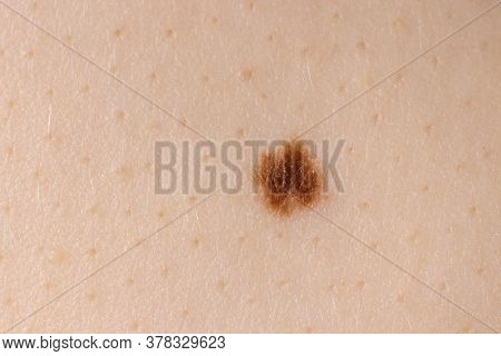 Mole Birthmark Nevus Macro Photo On Human Skin. Close Up.