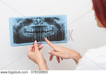 Doctor Orthodontist Analyzes The Orthopantomogram Of The Patient's Jaws To Diagnose