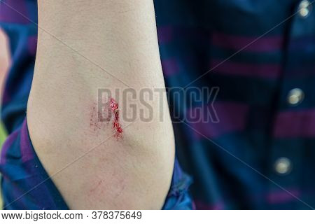 Injuries From Falling In The Garden.\na Man Showing A Lesion On His Arm. Arm Is Wound From A Knife. 