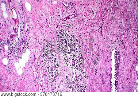 Breast Ductal Carcinoma, Light Micrograph, Photo Under Microscope
