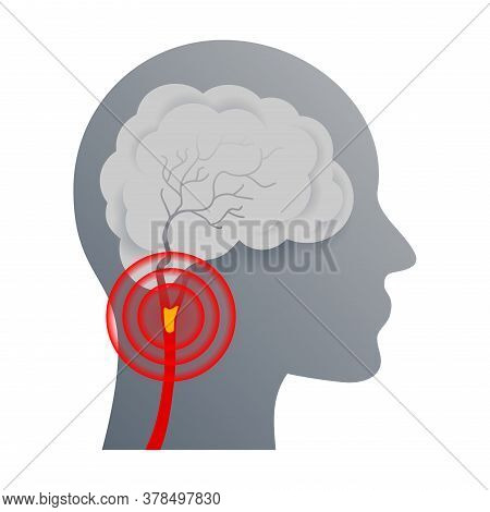 Cerebrovascular Disease That Affect The Blood Vessels Of Brain And Cerebral Circulation And Damaged 