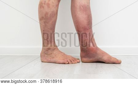 Close Up Photo Of Legs With Lymphostasis And Psoriasis.