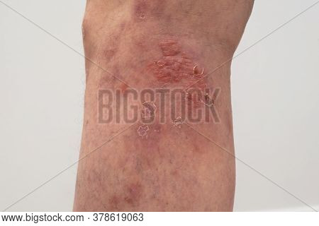 Close Up Photo Of Leg With Psoriasis.