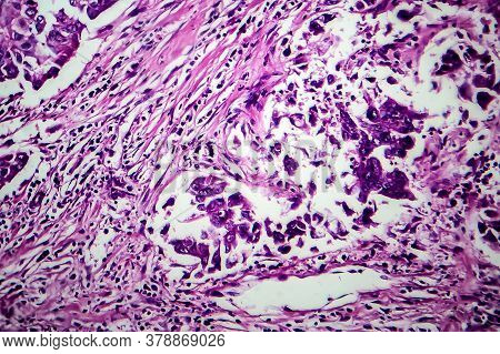 Breast Ductal Carcinoma, Light Micrograph, Photo Under Microscope