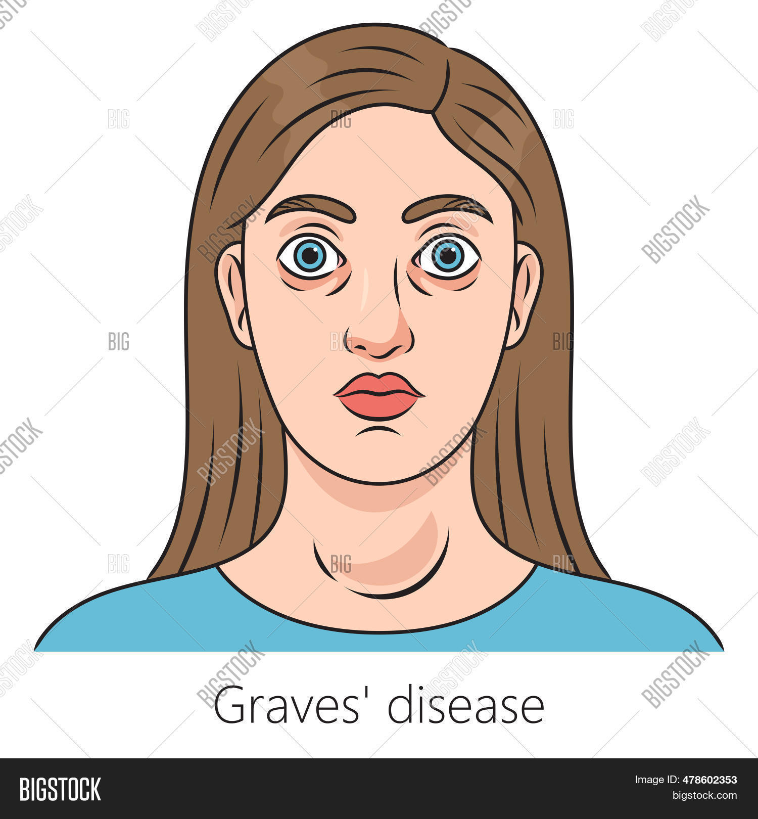 Woman Graves Disease Image & Photo (Free Trial) Bigstock
