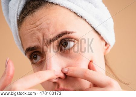 Woman Close Up Face Squeezing Pimples. Acne Blemish Spots Skin On Young Woman. Spot Scar Acne, Freck