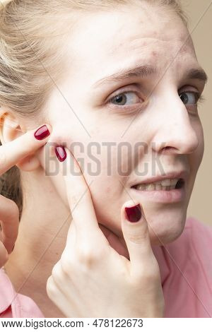 Caucasian Blond Female Girl Using Point Fingers For Pimples Squeezing Against Beige. Vertical Image