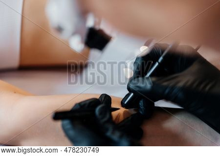 Doctor Is Doing Electroepilation To The Client, Using Electro Needle And Tweezers. Hair Removal Proc