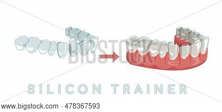 Invisible Braces Aligner, Retainer. Medical Drawing In Cartoon Style.
