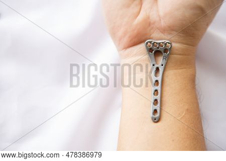 A Surgical Distal Radius Locking Plate On A Men's Wrist On A White Table