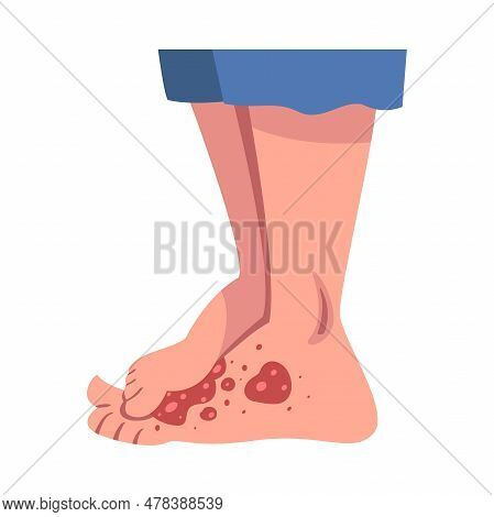 Legs With Skin Problem Suffering From Itching Vector Illustration