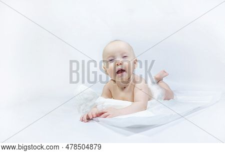 A Baby With A Hemangioma On His Neck Lies On A White Background. Banner With A Copy Space. Profile O