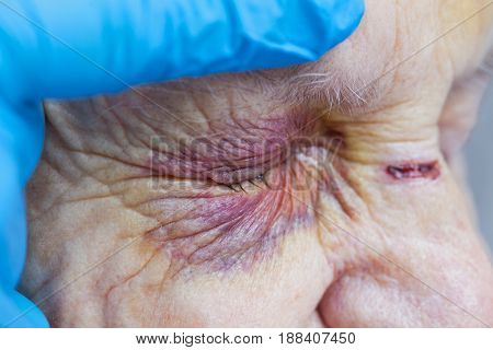 Close up picture of an elderly woman's injured eye and nurse's fingers