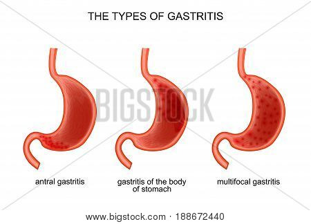 vector illustration of the types of gastritis