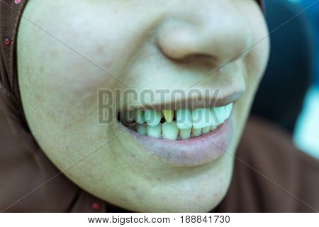 woman with bad teeth getting fixed