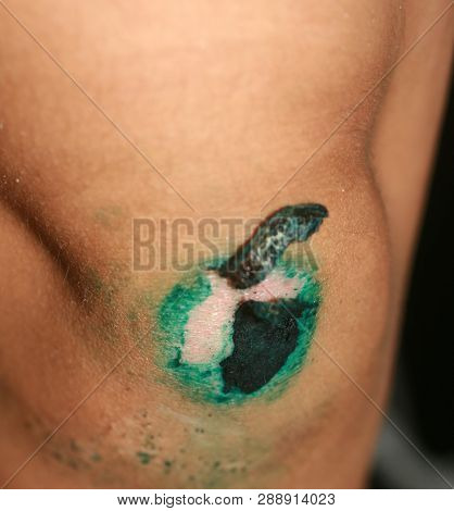 Healing Wound On The Knee. The Wound Treated With Brilliant Green. The Scab Will Climb