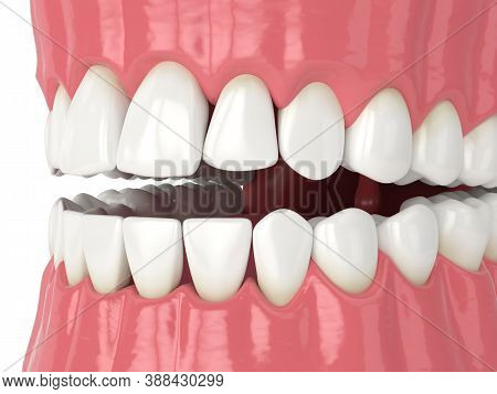 3d Render Of Human Jaw With Black Triangles Between Teeth Isolated Over White Background