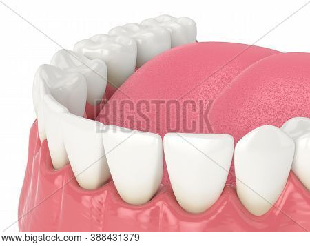 3d Render Of Human Jaw With Black Triangles Between Teeth Isolated Over White Background