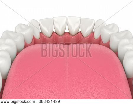 3d Render Of Human Jaw With Black Triangles Between Teeth Isolated Over White Background