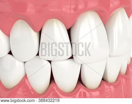 3d Render Of Human Jaw With Black Triangles Between Teeth Isolated Over White Background