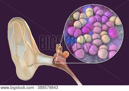 Otitis Media, Inflammatory Disease Of The Middle Ear, 3d Illustration