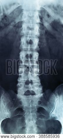 X-ray Of Lumbar Spine, Classical Radiology Rtg Of Lower Back