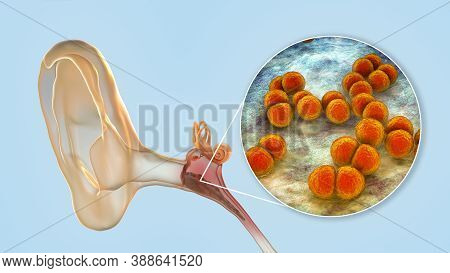 Otitis Media, Inflammatory Disease Of The Middle Ear, 3d Illustration