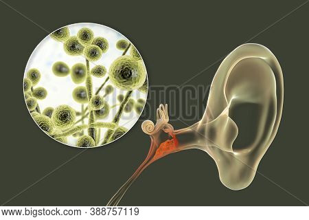 Chronic Suppurative Otitis Media Caused By Fungi Candida, Inflammatory Disease Of The Middle Ear, 3d