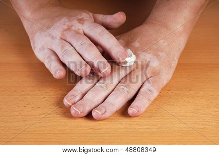Vitiligo